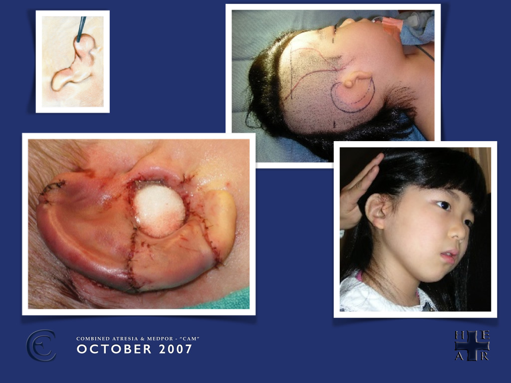 Combined Atresia Microtia (CAM) Surgery Photos