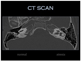 CT Scan of Atresia