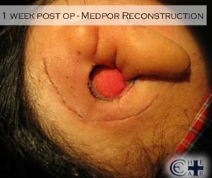 1 Week Post Op - Medpor Reconstruction
