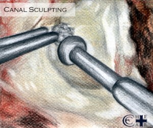 Canal Sculpting