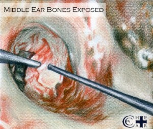 Middle Ear Bones Exposed