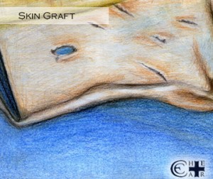 Skin Graft